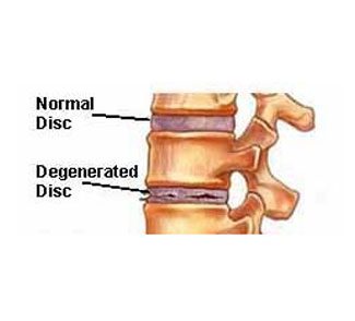 degenerative-disc-disease