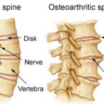 Degenerative Joint Disease & Osteoarthritis