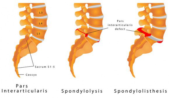 Spondyllisthesis & Chiropractic Care