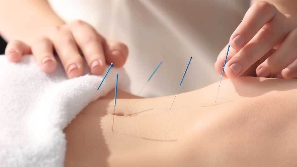 A person is getting acupuncture needles out of their arm.