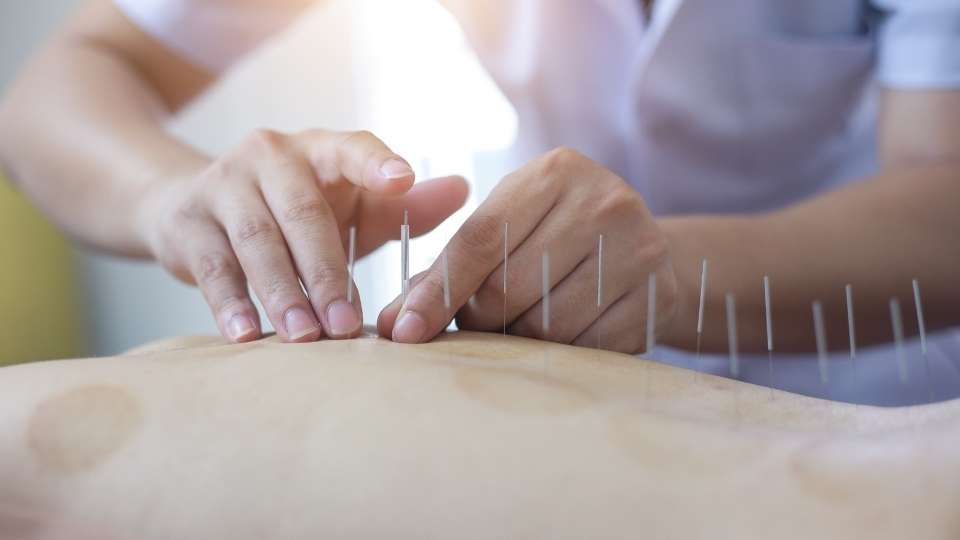 A person is using acupuncture needles on the back of a woman.