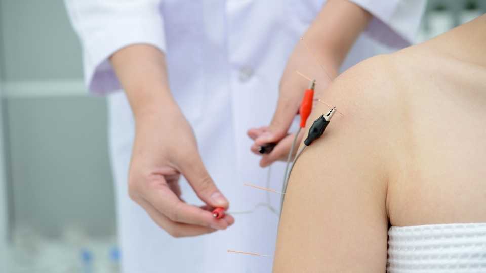 Electrical Stimulation of Acupuncture Needles