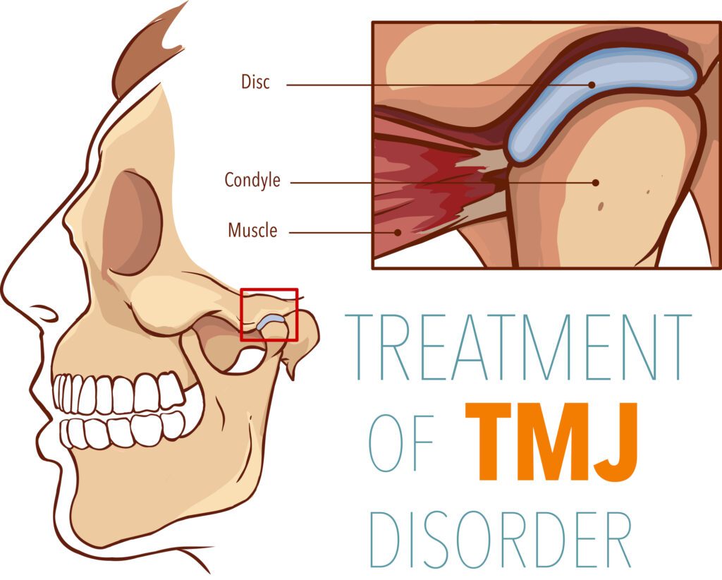 A graphic of the side view of tmj disorder