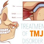 TMJ Pain & Chiropractic Care