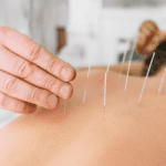 How Acupuncture Helps with Weight Loss