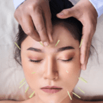 A woman getting acupuncture on her forehead