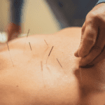 How Acupuncture Helps with Chronic Pain Management