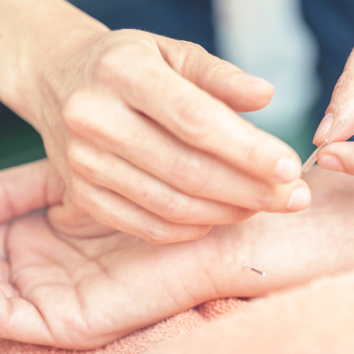 patient receiving acupuncture on her arm